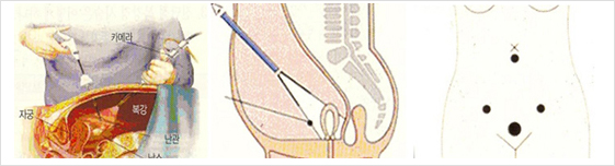 복강내시경하 자궁근종절제술
