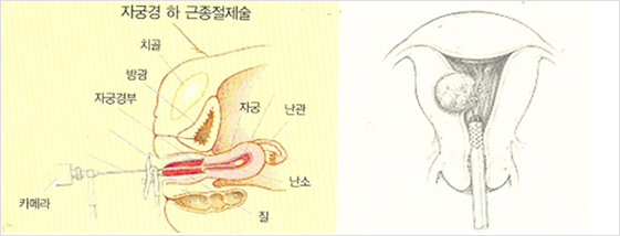 자궁내시경하 자궁근종절제술