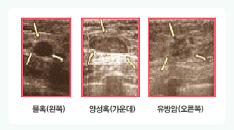 유방초음파