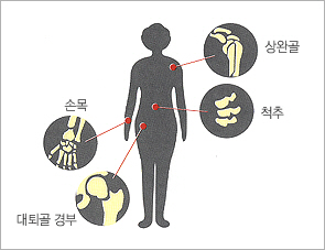 골다공증에 의한 골절의 4대 호발부위